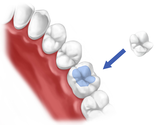 dental inlays onlays notting hill dentist w2 number 18 dental onlay